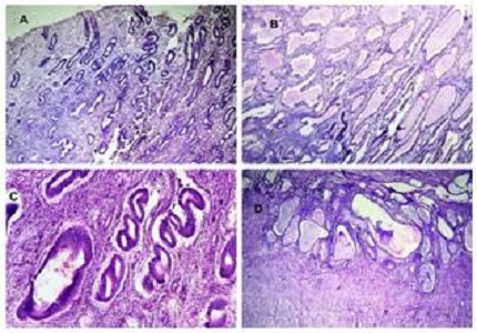 Histopathological study of endometrial lesions in tertiary care hospital