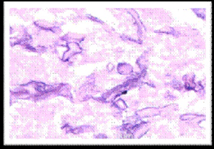 Histopathological profile of sinonasal lesions with brief clinical correlation: experience in a tertiary care centre