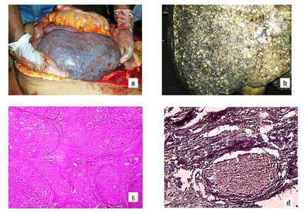 Liver autopsy study – incidental pathological findings