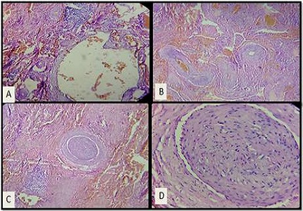 Intraorbital, extraconal cavernous hemangioma: a common tumor at an uncommon site-a case report