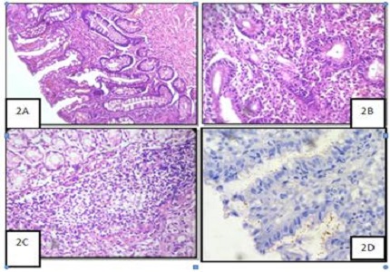 Significance of histologic grading using visual analogue scale in chronic gastritis
