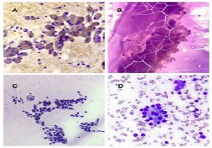 FNAC study of thyroid lesions using the Bethesda system