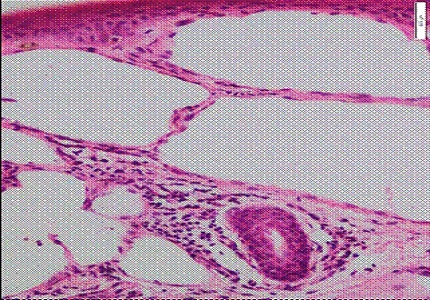 Idiopathic adult onset Lymphangioma circumscriptum of scrotum: An unusual case Scrotal lymphangioma circumscriptum