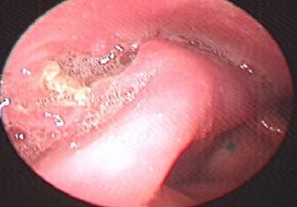 A rare case of Actinomycosis of the pyriform sinus mimicking malignancy