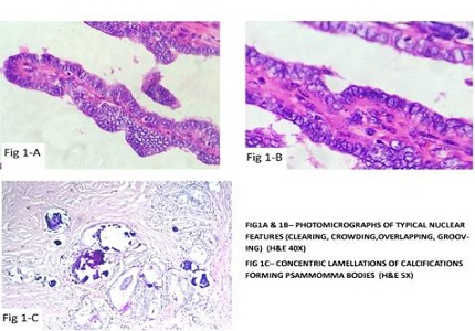 Histopathological spectrum of papillary carcinoma thyroid – a 4 year retrospective analysis