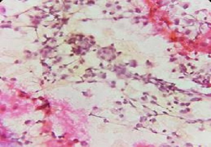 Fine needle aspiration cytology-a boon in the diagnosis of cutaneous metastasis