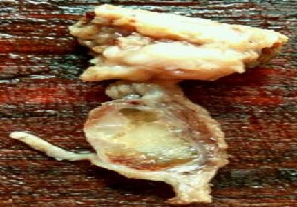 A rare case of papillary carcinoma in thyroglossal cyst