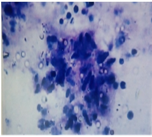 Rapid method of cytology diagnosis by supravital staining in FNAC of various tissue and organs