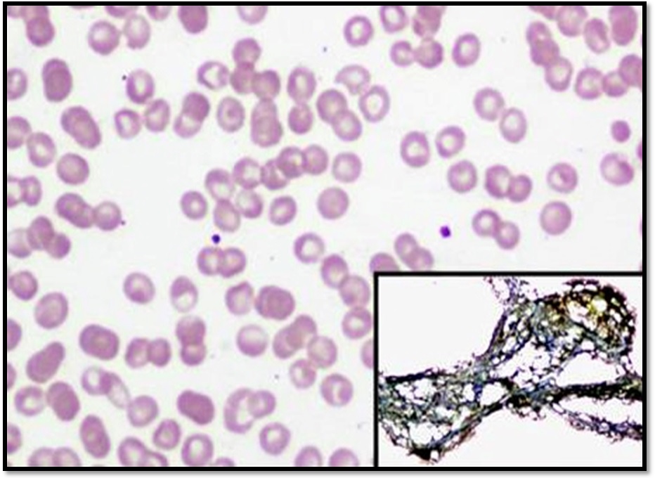 Pancytopenia: A multidisciplinary assessment of hemato-etiological and clinical spectrum in a tertiary care hospital