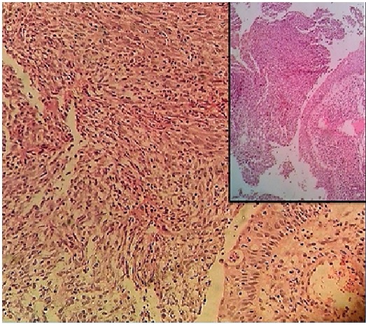 Two cases of spindle cell carcinoma with a histopathological review of biphasic tumours of head and neck