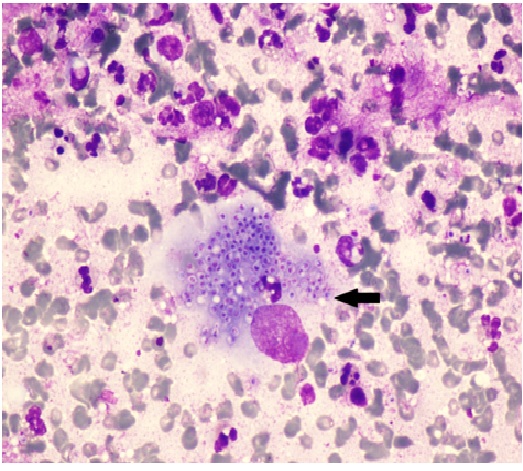 Isolated intramuscular histoplasmosis in an elderly - diagnosis by fine needle aspiration cytology