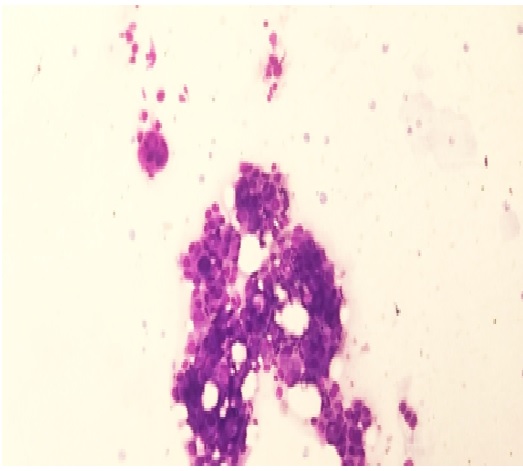 Howell’s cytological grading of breast carcinomas - comparison with histological grading and its association with lymph node metastasis