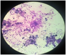 Study of image guided fine needle aspiration cytology in cases of hepatic mass lesions