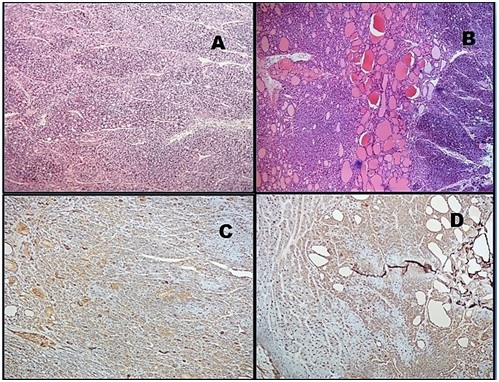 Diagnostic challenge of follicular thyroid carcinoma with insular component mixed with follicular patterned papillary carcinoma