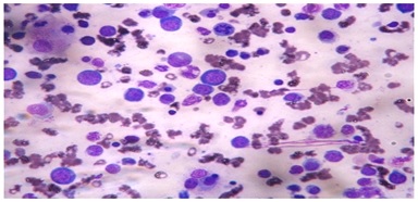 A clinicopathological study of severe non-haemolytic anemia in age group of 0-18 years