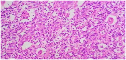 Cytological and histopathological diagnosis of a multifocal Rosai dorfman disease with involvement of Pinna– A rare case report