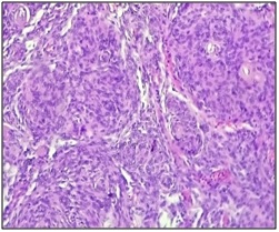 Histopathological study of meningioma in a tertiary care centre: a two years experience