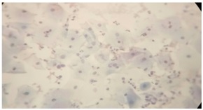 Comparison of different methods of fixation in Papanicolaou staining of cervical smears: Wet-fixation and rehydration of air dried smears
