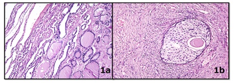 Histopathological study of Non-neoplastic & Neoplastic ovarian lesions in a tertiary care hospital in Gujarat, India