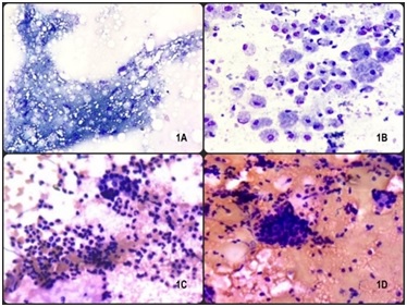 Cytopathological study of salivary gland lesions in rural population: Use of the Milan system for reporting