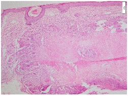 Lupus Miliaris Disseminatus Facei: An uncommon cause of Non-infectious granulomatous dermatitis