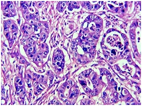 The role of tumour infiltrating mast cells (TIM) in gastric carcinoma remains an enigma : Clinicopathological correlation of mast cell density