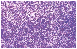 Study of lymphnode lesions by fine needle aspiration cytology and histopathology: A study of 125 cases