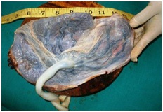 Morphological study of placenta in hypertensive disorders in pregnancy