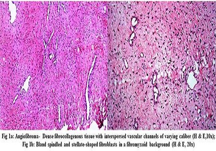 Clinico-pathological study of benign soft tissue tumors: a study from tertiary teaching hospital