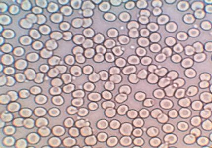 A simple and reliable method to estimate platelet counts that will help in an emergency