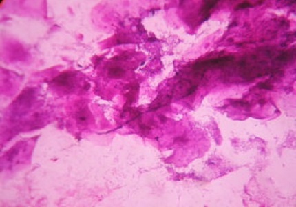 Cytologic Manifestations of Vaginitis