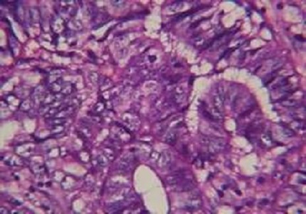 A study of PTEN expression in endometrial hyperplasia and endometrioid type of endometrial carcinoma