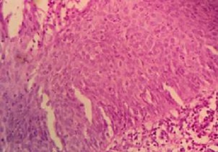 Histopathological spectrum of cervical biopsies – a 5 year retrospective study
