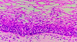 Histopathological spectrum of Cervical Lesion”– two and half Year