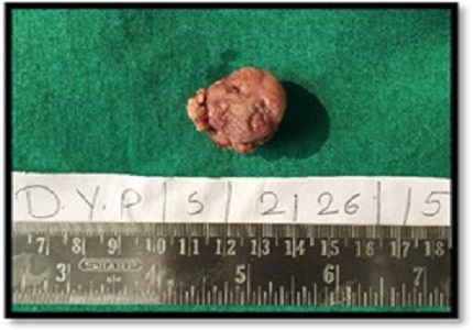 Intestinal Type of cystitis glandularis mimicking bladder tumor- case report and review of literature