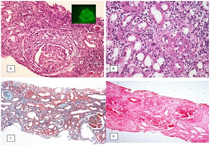 Crescents in renal biopsies and crescentic glomerulonephritis - A 5 year study from South India