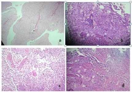 Histopathological overview of cystoscopic bladder biopsies- A retrospective analysis