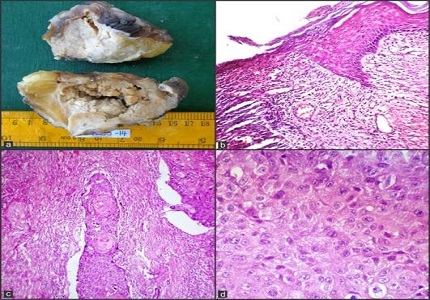 Primary squamous cell carcinoma of breast: A Rare Case Report