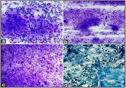 Cytological spectrum of lymph node lesions-our institute experience
